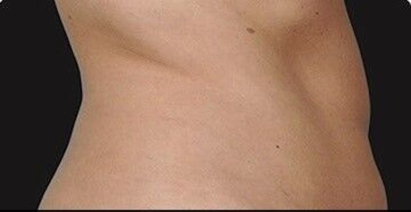 CoolSculpting Before & After Gallery - Patient 55344817 - Image 1