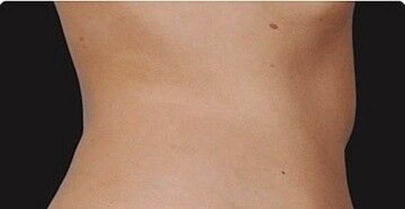 CoolSculpting Before & After Gallery - Patient 55344817 - Image 2