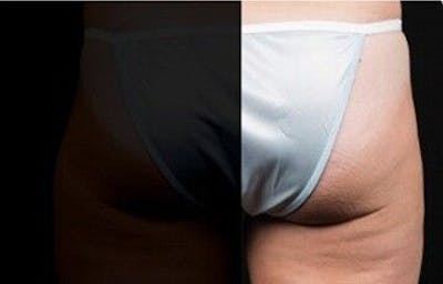 CoolSculpting Before & After Gallery - Patient 55344819 - Image 1