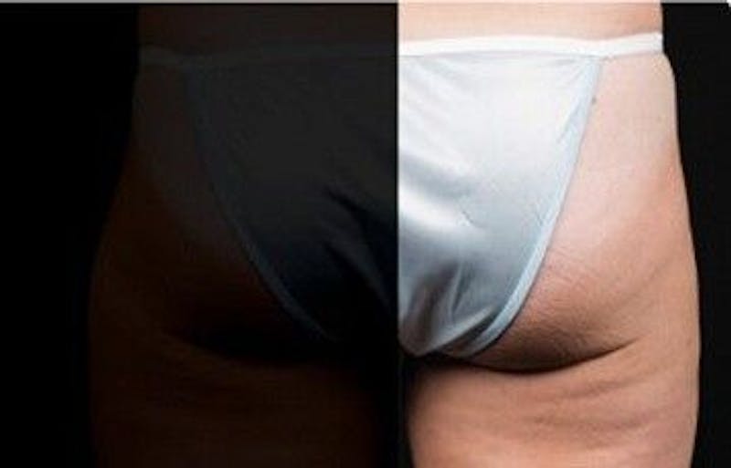 CoolSculpting Before & After Gallery - Patient 55344819 - Image 1