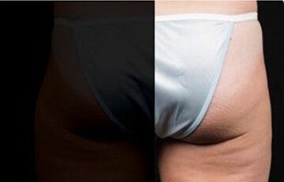 CoolSculpting Before & After Gallery - Patient 55344819 - Image 2
