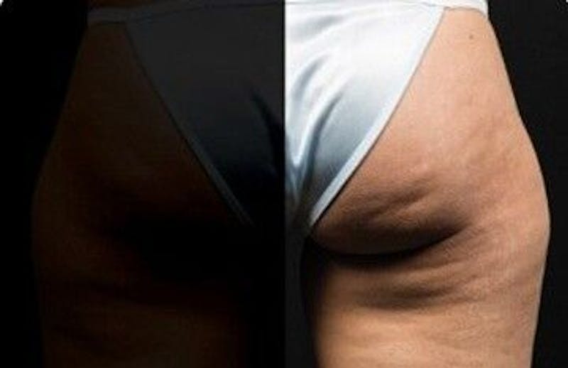 CoolSculpting Before & After Gallery - Patient 55344821 - Image 1