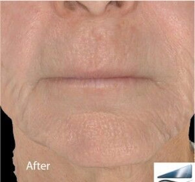 Infini Genius Before & After Gallery - Patient 55344820 - Image 2