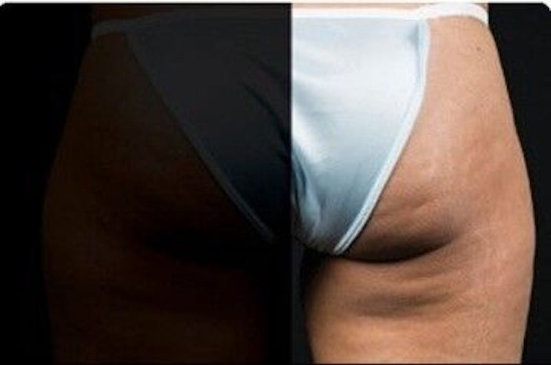 CoolSculpting Before & After Gallery - Patient 55344821 - Image 2