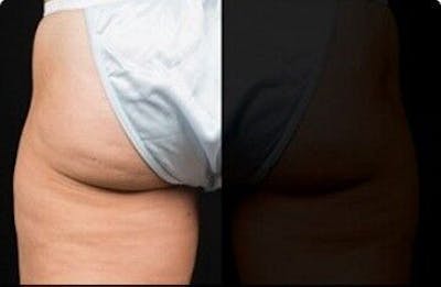 CoolSculpting Before & After Gallery - Patient 55344823 - Image 1
