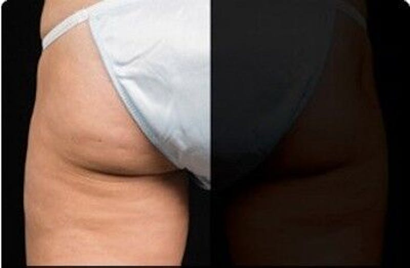 CoolSculpting Before & After Gallery - Patient 55344823 - Image 2