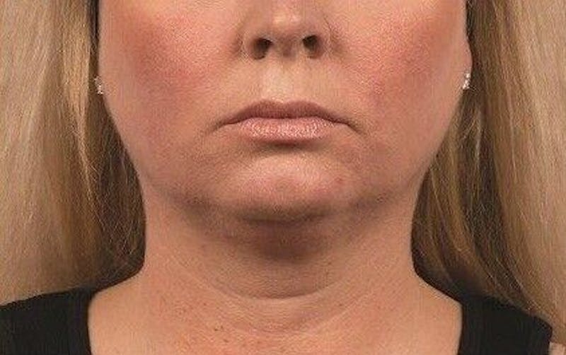 CoolSculpting Before & After Gallery - Patient 55344828 - Image 1