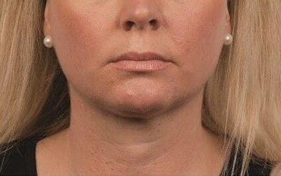 CoolSculpting Before & After Gallery - Patient 55344828 - Image 2