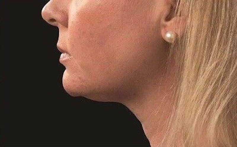 CoolSculpting Before & After Gallery - Patient 55344830 - Image 2