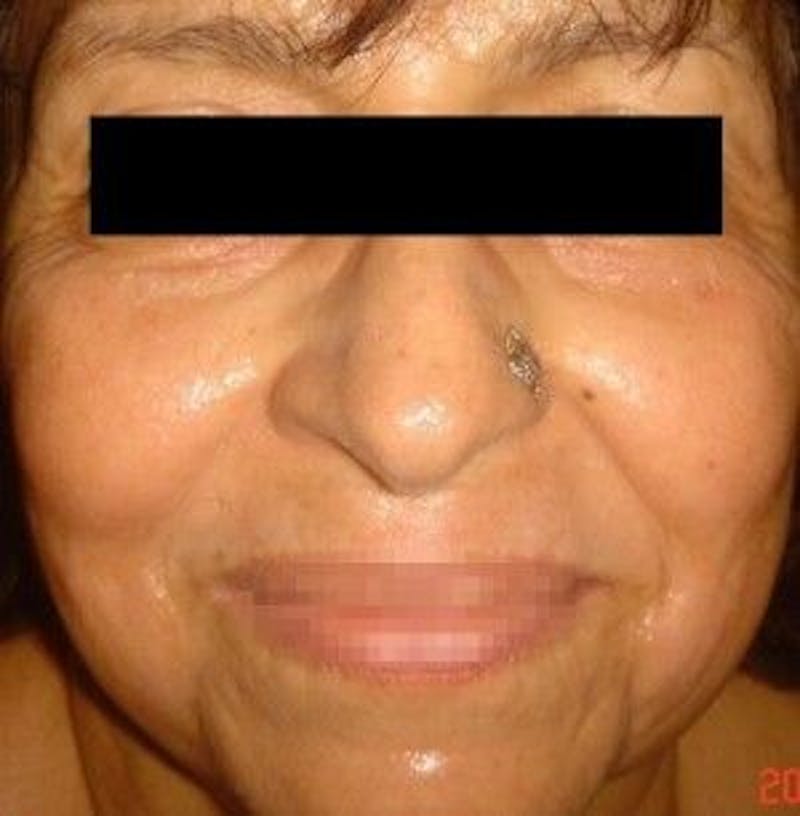 Infini Genius Before & After Gallery - Patient 55344832 - Image 2