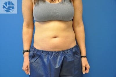 CoolSculpting Before & After Gallery - Patient 55344841 - Image 1
