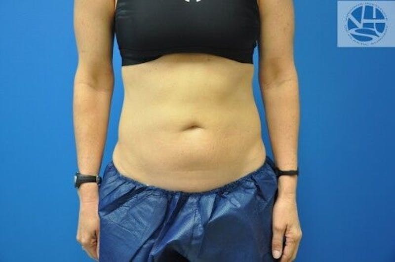 CoolSculpting Before & After Gallery - Patient 55344841 - Image 2