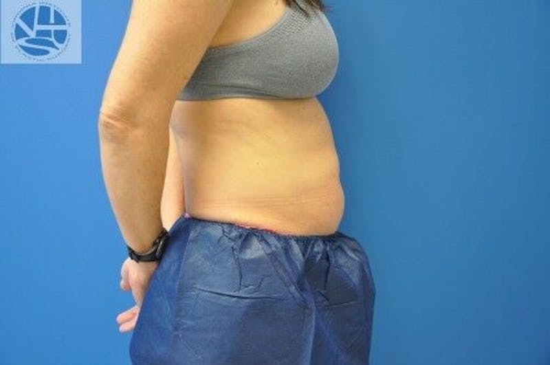 CoolSculpting Before & After Gallery - Patient 55344841 - Image 3