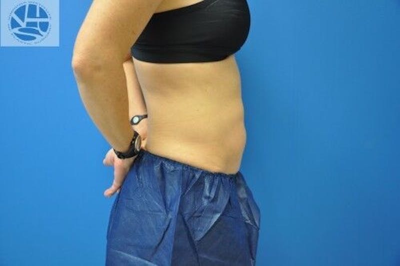 CoolSculpting Before & After Gallery - Patient 55344841 - Image 4