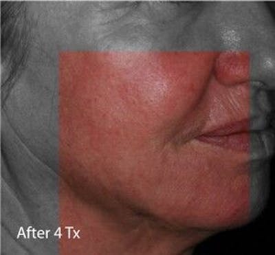 Infini Genius Before & After Gallery - Patient 55344836 - Image 2