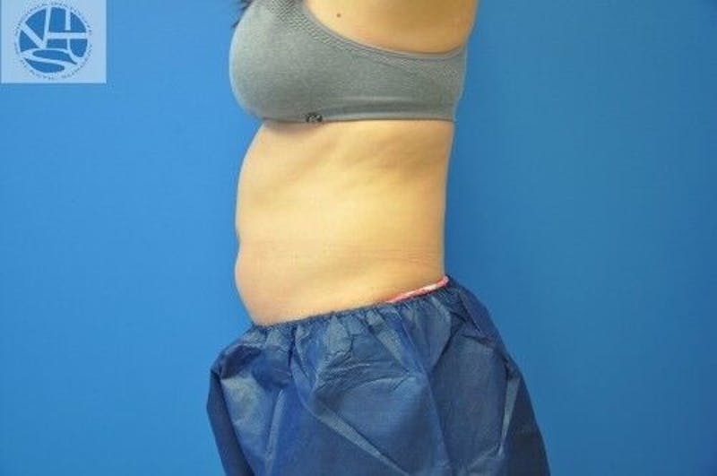 CoolSculpting Before & After Gallery - Patient 55344841 - Image 5