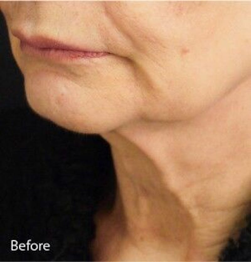 Infini Genius Before & After Gallery - Patient 55344837 - Image 1