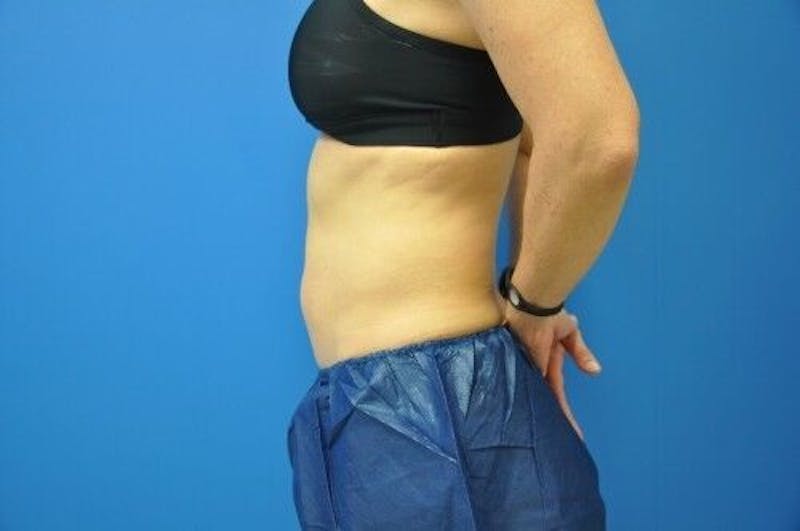 CoolSculpting Before & After Gallery - Patient 55344841 - Image 6