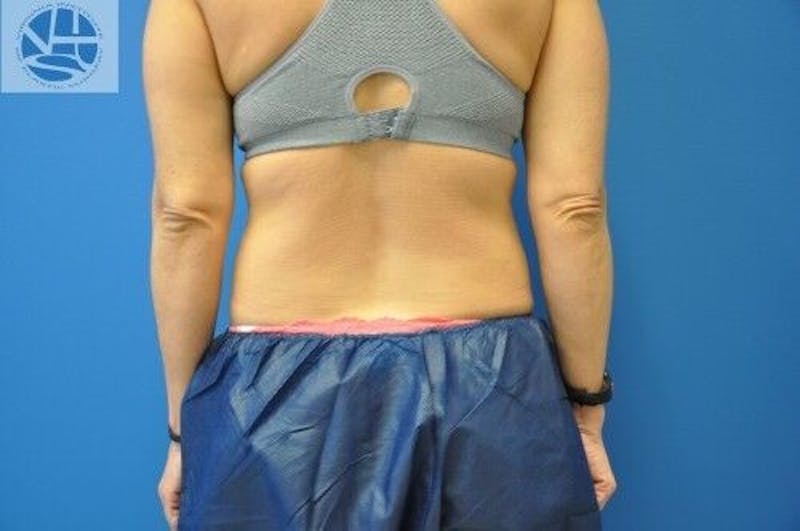 CoolSculpting Before & After Gallery - Patient 55344841 - Image 7
