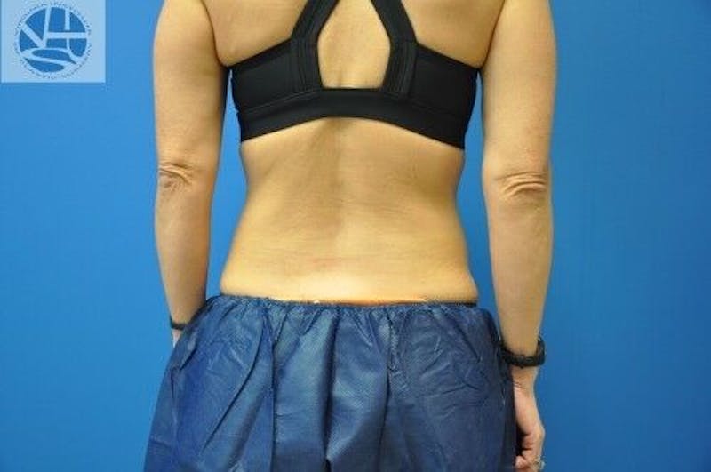 CoolSculpting Before & After Gallery - Patient 55344841 - Image 8
