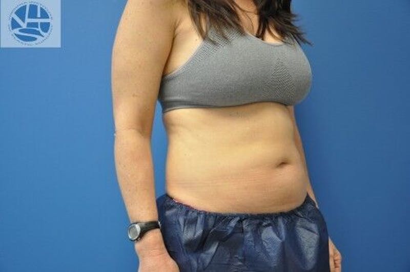 CoolSculpting Before & After Gallery - Patient 55344841 - Image 9