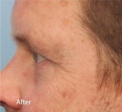 Infini Genius Before & After Gallery - Patient 55344840 - Image 2