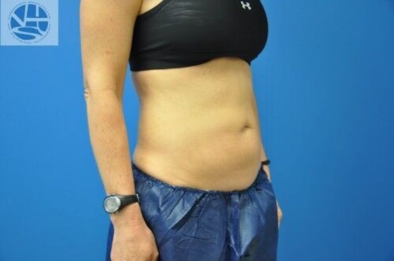 CoolSculpting Before & After Gallery - Patient 55344841 - Image 10