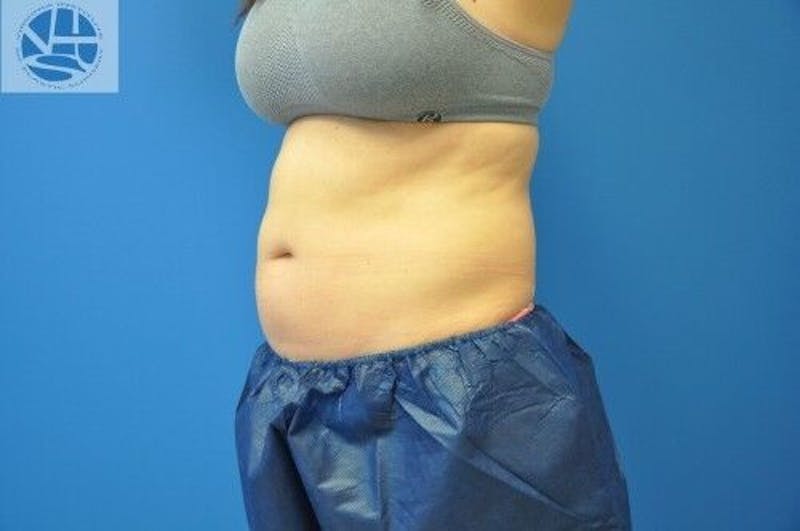 CoolSculpting Before & After Gallery - Patient 55344841 - Image 11
