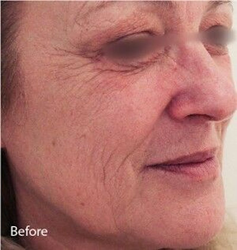 Infini Genius Before & After Gallery - Patient 55344842 - Image 1
