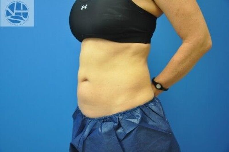 CoolSculpting Before & After Gallery - Patient 55344841 - Image 12