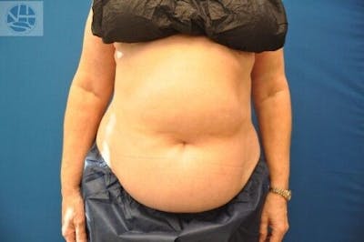 CoolSculpting Before & After Gallery - Patient 55344847 - Image 1