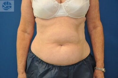 CoolSculpting Before & After Gallery - Patient 55344847 - Image 2