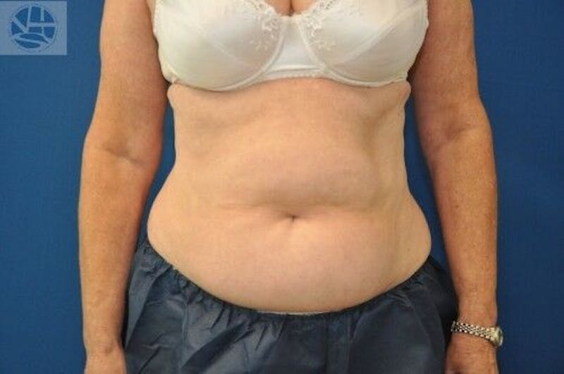 CoolSculpting Before & After Gallery - Patient 55344847 - Image 2