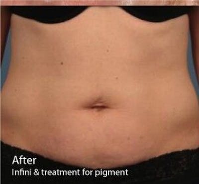 Infini Genius Before & After Gallery - Patient 55344843 - Image 2