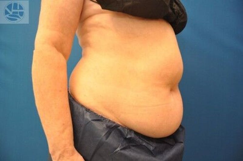 CoolSculpting Before & After Gallery - Patient 55344847 - Image 3