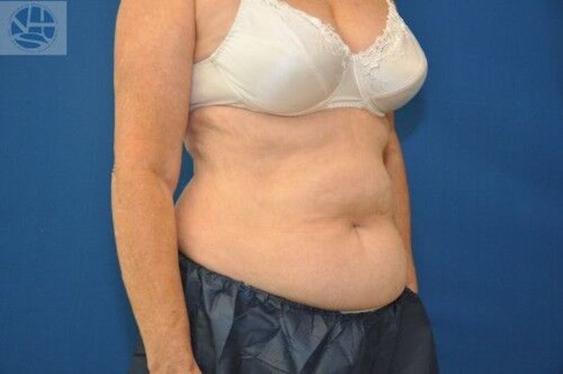 CoolSculpting Before & After Gallery - Patient 55344847 - Image 4