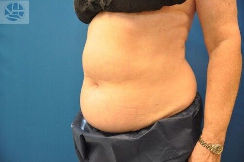 CoolSculpting Before & After Gallery - Patient 55344847 - Image 5