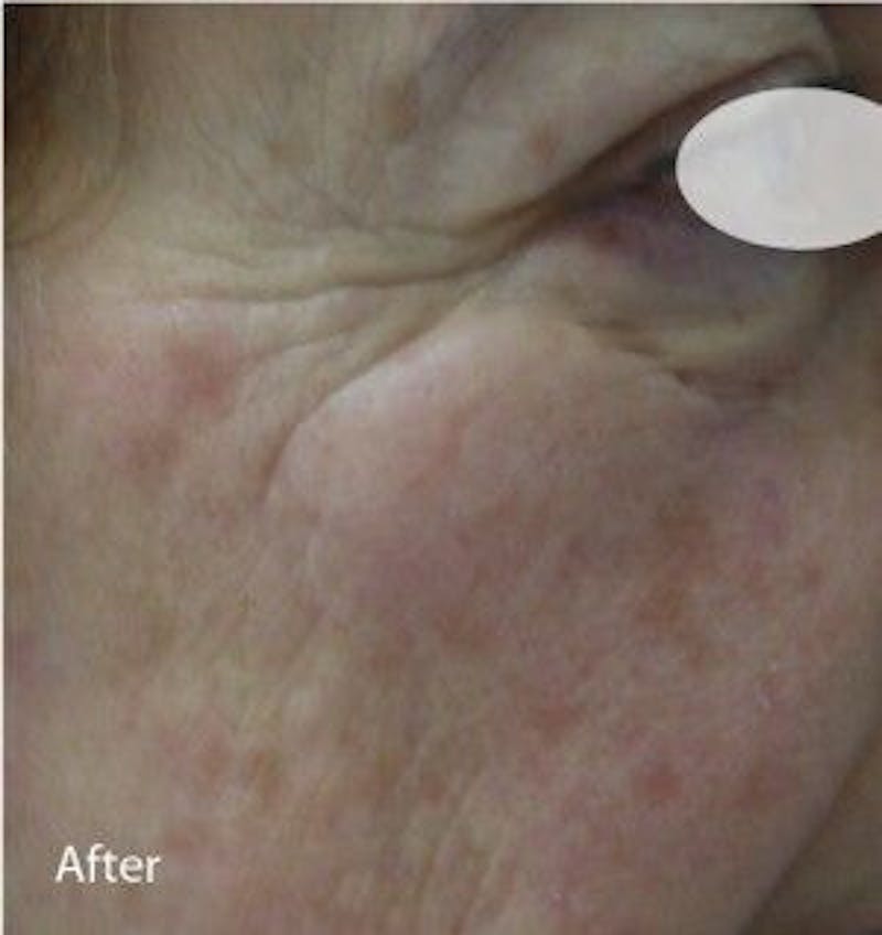 Infini Genius Before & After Gallery - Patient 55344844 - Image 2