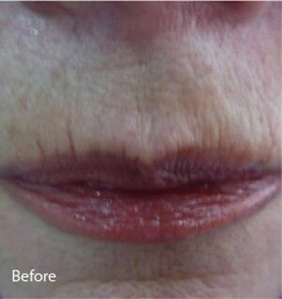 Infini Genius Before & After Gallery - Patient 55344846 - Image 1