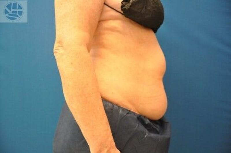 CoolSculpting Before & After Gallery - Patient 55344847 - Image 7
