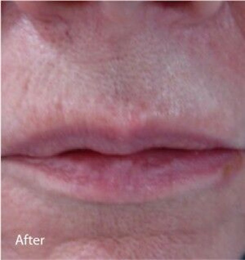 Infini Genius Before & After Gallery - Patient 55344846 - Image 2