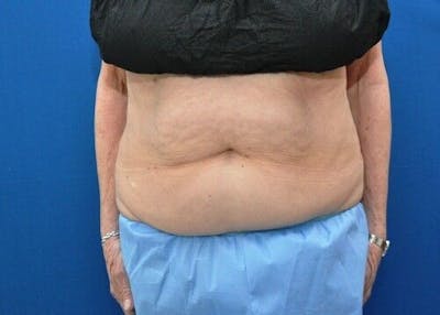 CoolSculpting Before & After Gallery - Patient 55344852 - Image 1