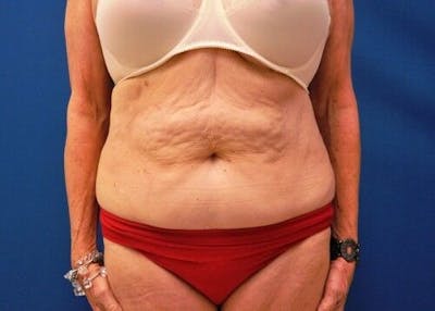CoolSculpting Before & After Gallery - Patient 55344852 - Image 2