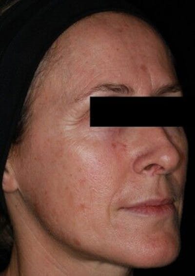 Infini Genius Before & After Gallery - Patient 55344851 - Image 1