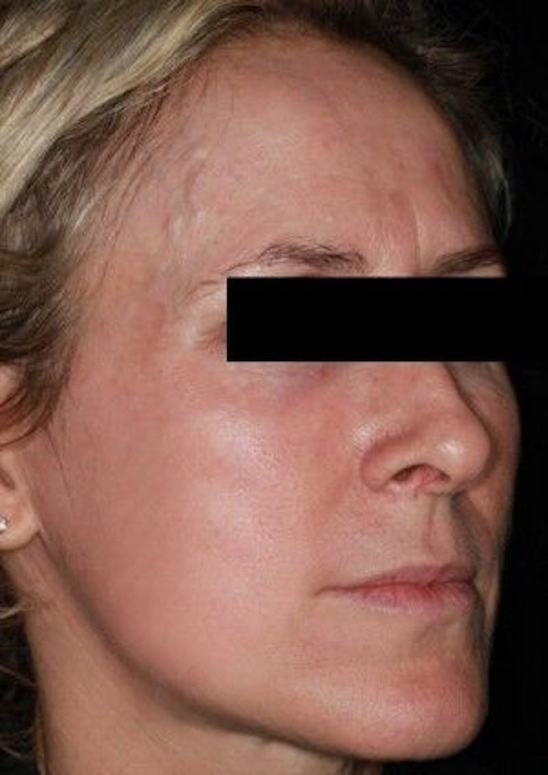 Infini Genius Before & After Gallery - Patient 55344851 - Image 2