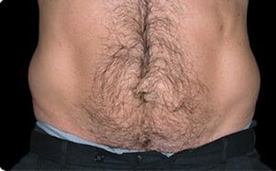 CoolSculpting Before & After Gallery - Patient 55344857 - Image 1