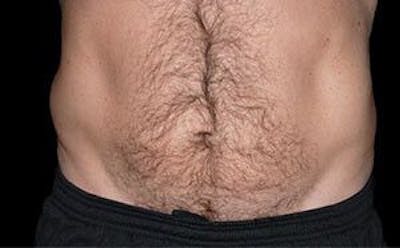 CoolSculpting Before & After Gallery - Patient 55344857 - Image 2