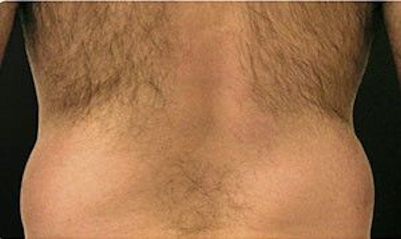 CoolSculpting Before & After Gallery - Patient 55344857 - Image 3
