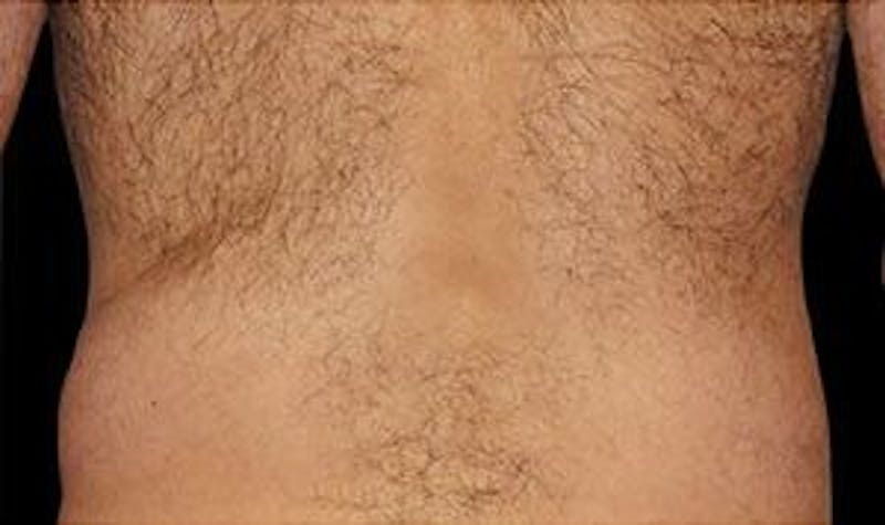 CoolSculpting Before & After Gallery - Patient 55344857 - Image 4