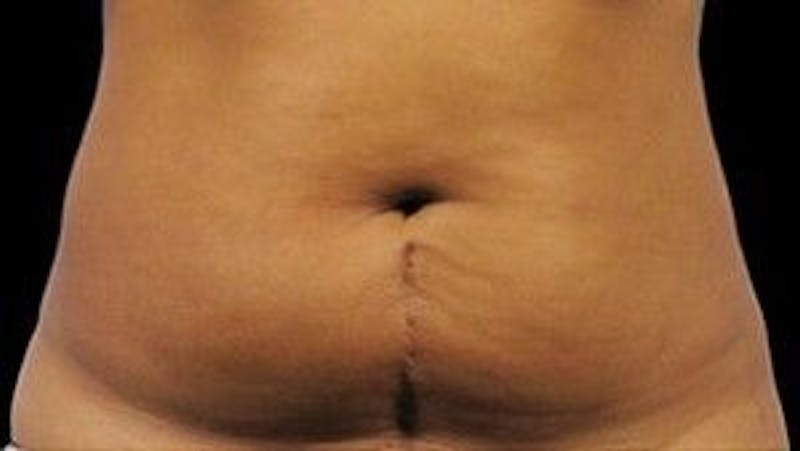 CoolSculpting Before & After Gallery - Patient 55344860 - Image 1